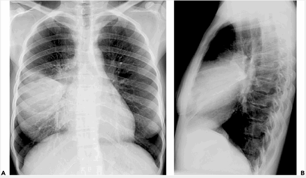 Điều dưỡng chăm sóc bệnh nhân viêm phổi thùy