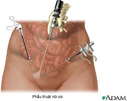 Phẫu thuật nội soi