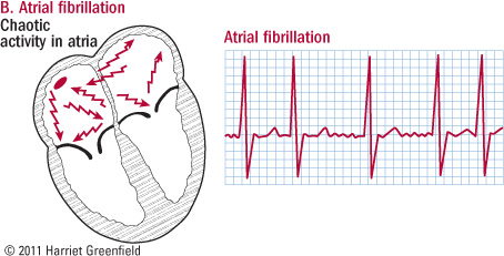 Tìm hiểu về rung nhỉ (Atrial Fibrillation)