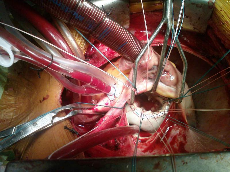 Dụng cụ trong phẫu thuật tim mạch