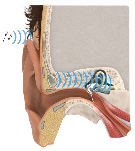 boneconductionimplant-2.