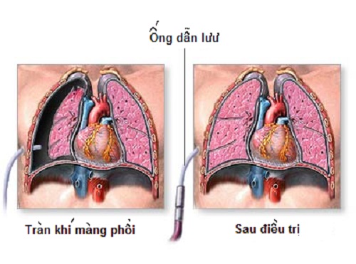 Điều dưỡng chăm sóc bệnh nhân tràn dịch màng phổi