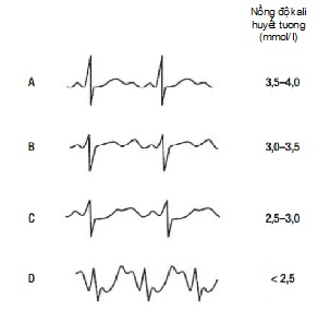 Thumbnail Theo dõi tình trang rối loạn Kali ở người bệnh