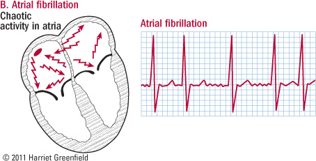 Thumbnail Tìm hiểu về rung nhỉ (Atrial Fibrillation)