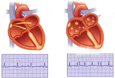 Thumbnail Điều dưỡng chăm sóc bệnh nhân rối loạn nhịp tim