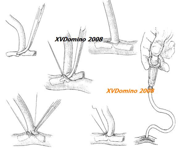 Thumbnail Chăm sóc bệnh nhân dẫn lưu Kerh